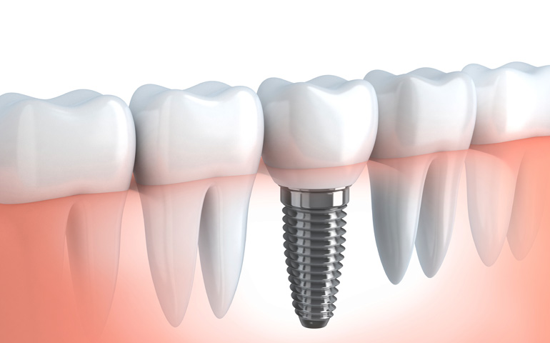 Los implantes, una alternativa muy eficiente ante la pérdida de piezas dentales