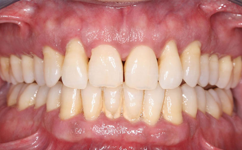 La periodontitis es una enfermedad crónica que puede generar la pérdida de hueso