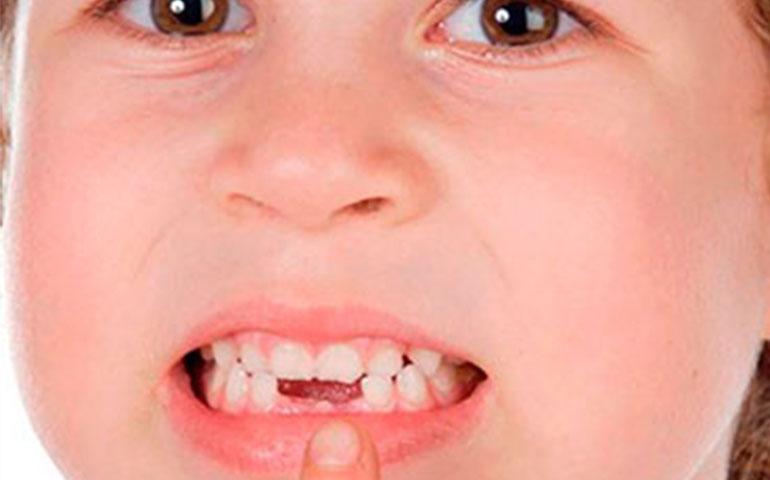 La ausencia congénita de algún diente, una situación más frecuente de lo que parece