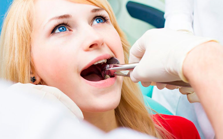 Extracción Dental (Exodoncia