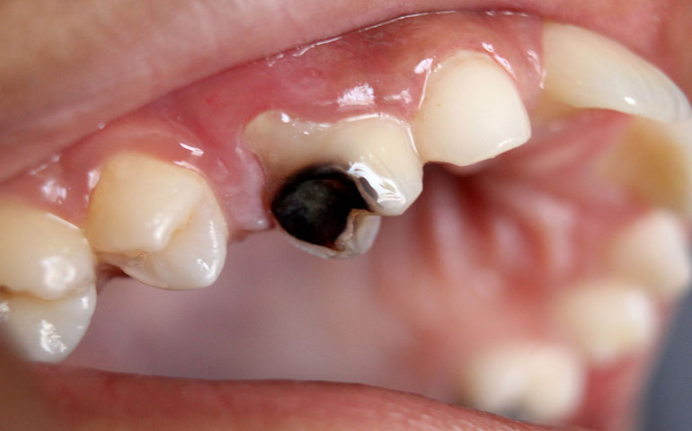 Un diente enfermo afecta negativamente a la salud de todo nuestro organismo