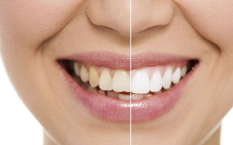 Cómo evitar manchas y que se amarillen los dientes