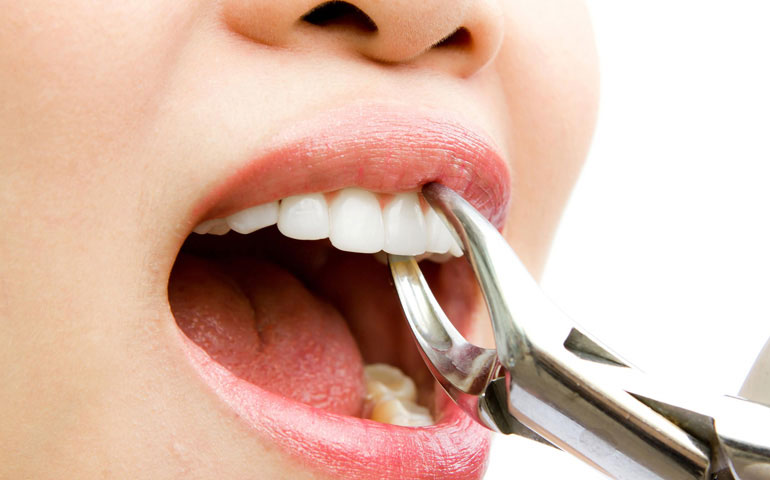 La extracción dentaria sigue siendo el trabajo de odontología más frecuente